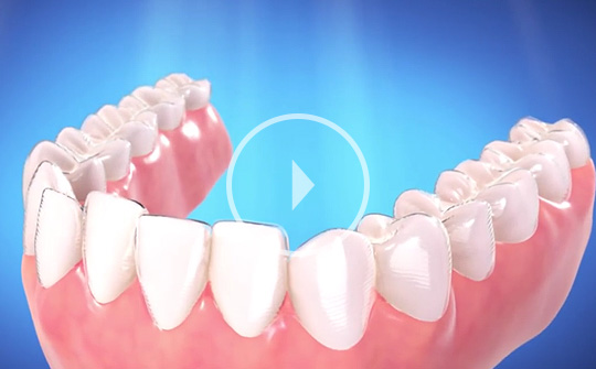How Invisalign and Invisalign Teen Work