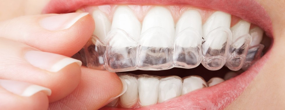 6 Useful Accessories for Your Invisalign Journey