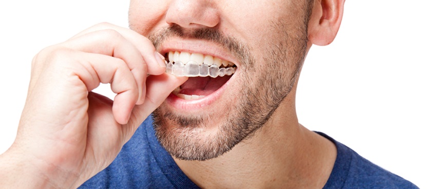 Steps to Follow When You've Lost an Invisalign Aligner Tray